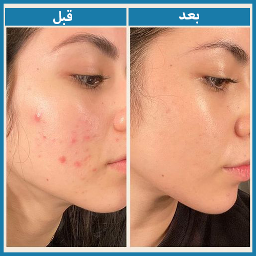ClariSkin حمض السيلاسيليك للبشرة