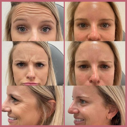 FACIAL CUPPING™ أكواب الحجامة لبشرة مشدودة طبيعيا