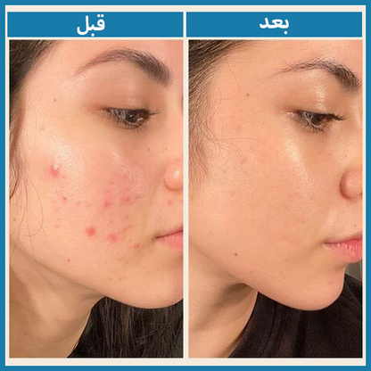 ClariSkin حمض السيلاسيليك للبشرة