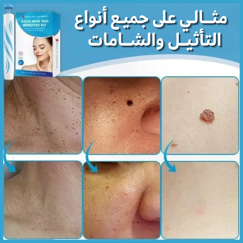 AUTO-MICRO™ المجموعة الأمريكية للتخلص من الثآليل طبيعيا