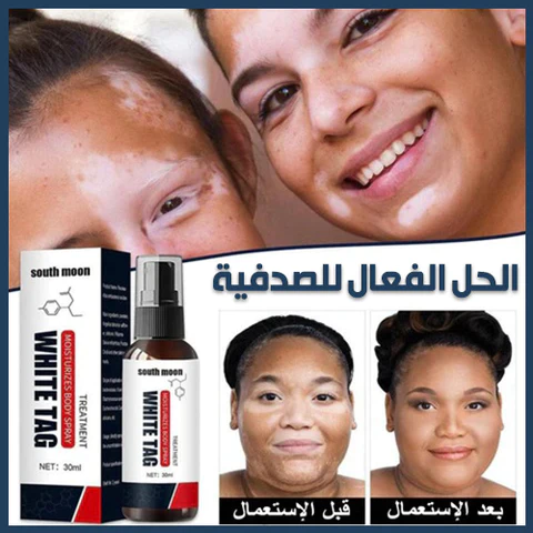 FLWHITE TAG™ الحل الأخير للتخلص من الصدفية و البهاق